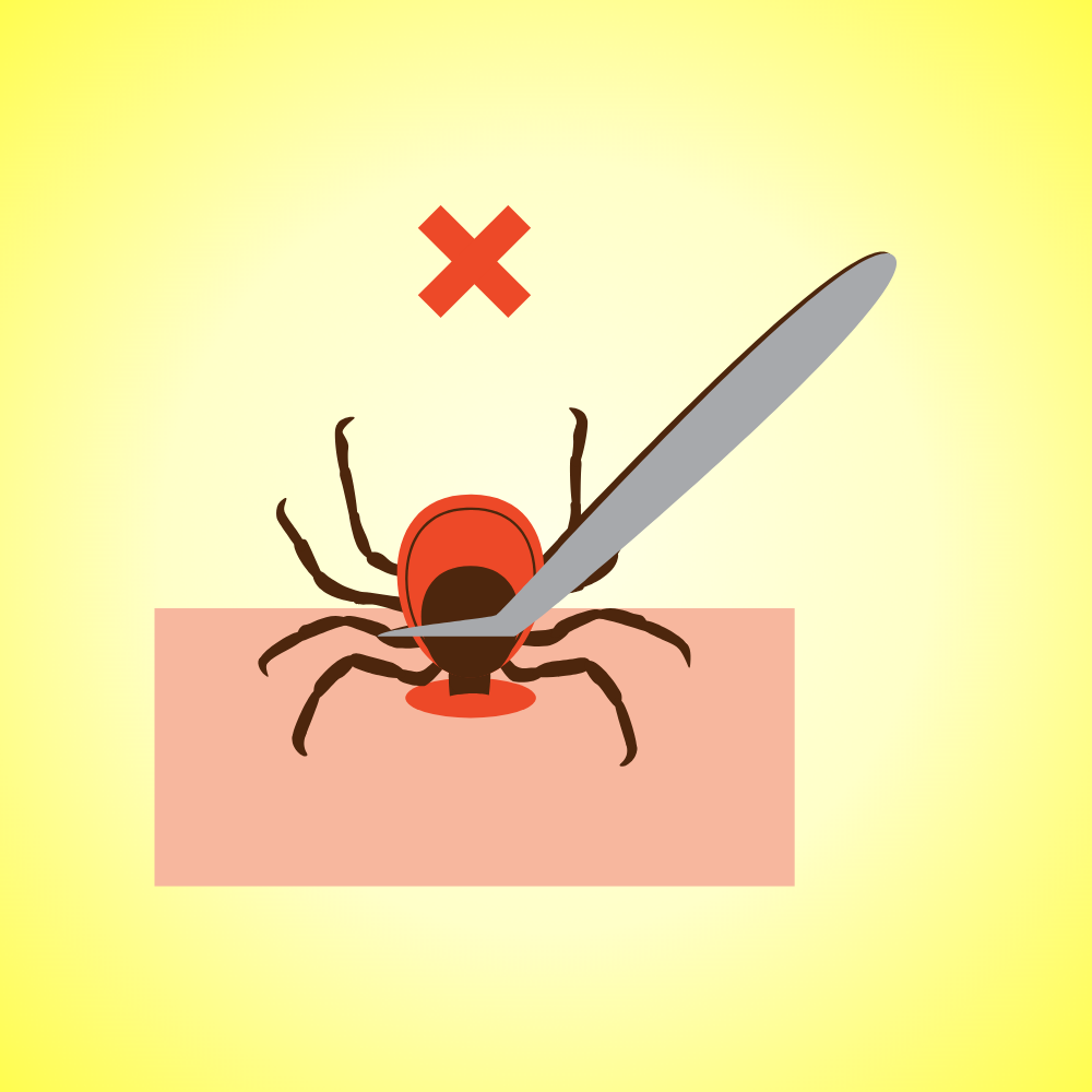 Tick Remover Tools